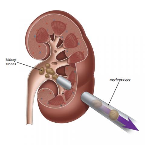 Retrograde Intra Renal Surgery Rirs Kidney Stones Treatment