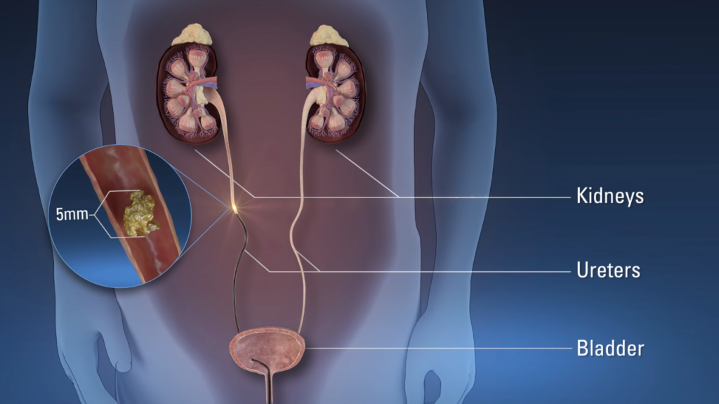 Ureteroscopic lithotripsy (URSL) – Kidney Stones Treatment
