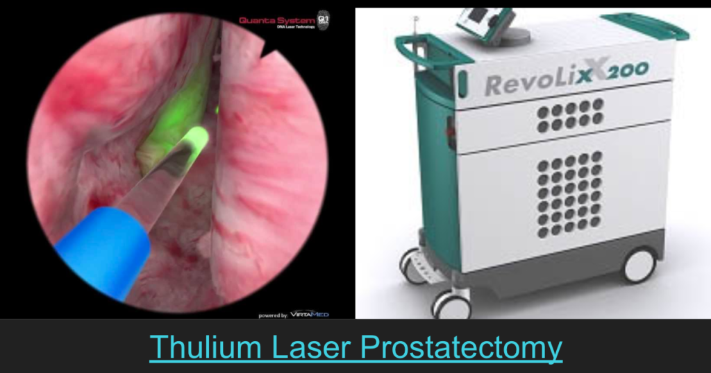 thulium laser prostatectomy