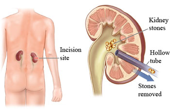 Treatments Of Mini Pcnl Flexible Nephroscopy Standards Pcnl Plus Laser Lithotripsy